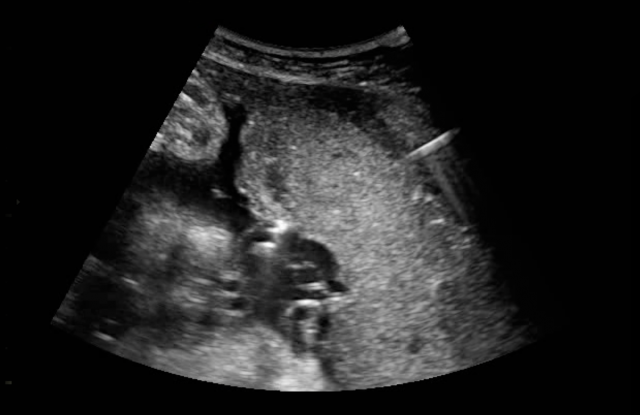 Intrauterine Transfusion