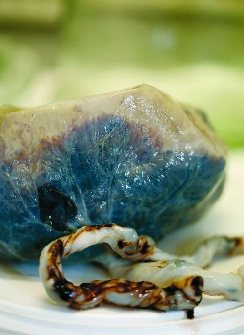 Stem Cell Transplantation