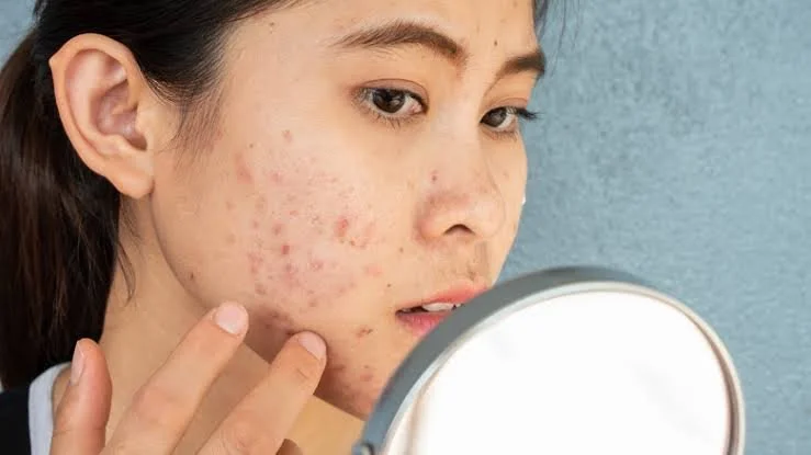 Your Gut Is Driving Your Skin Problem