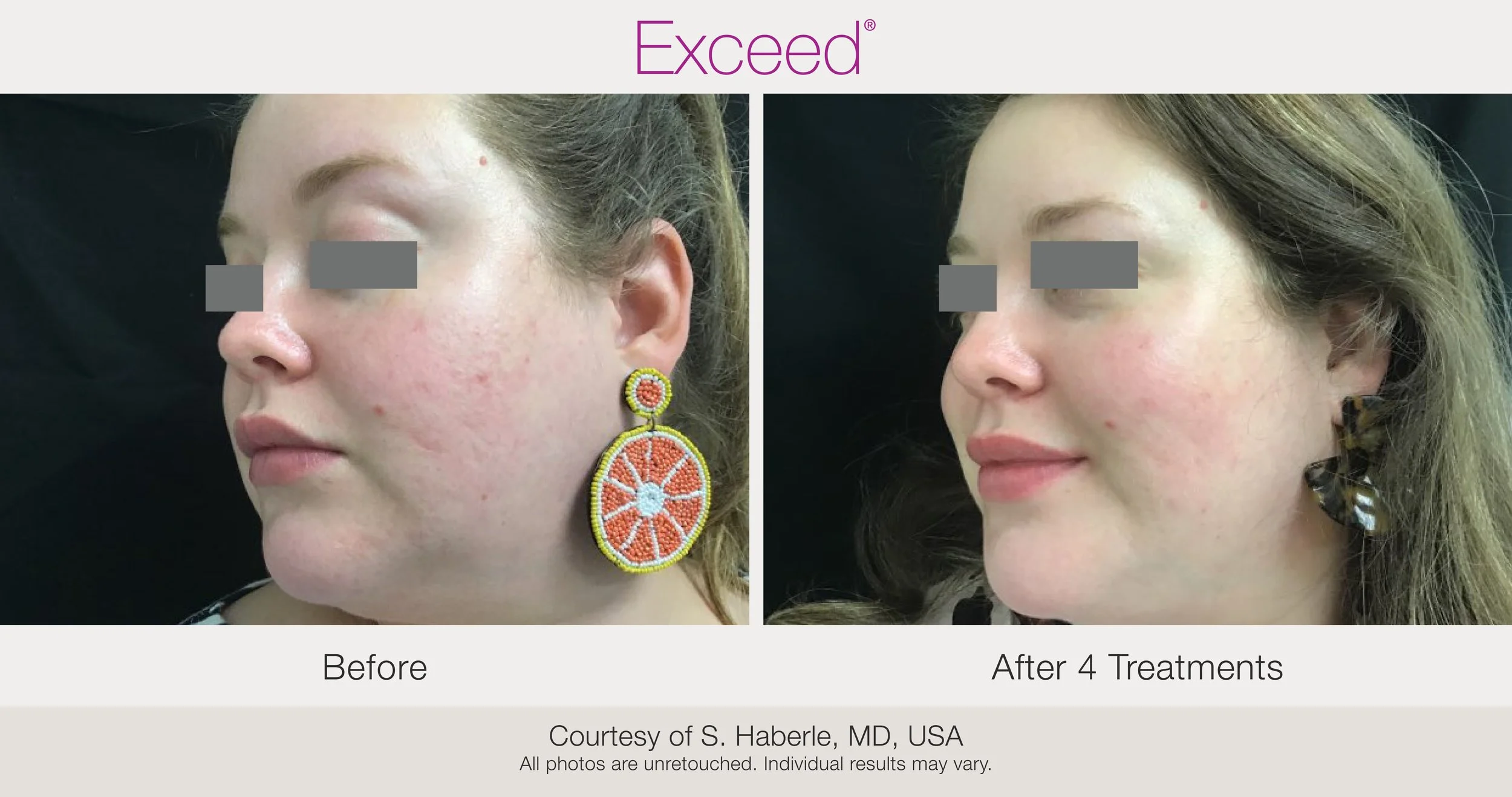 Exceed Microneedling in Austin, TX: The Ultimate Solution for Acne Scars