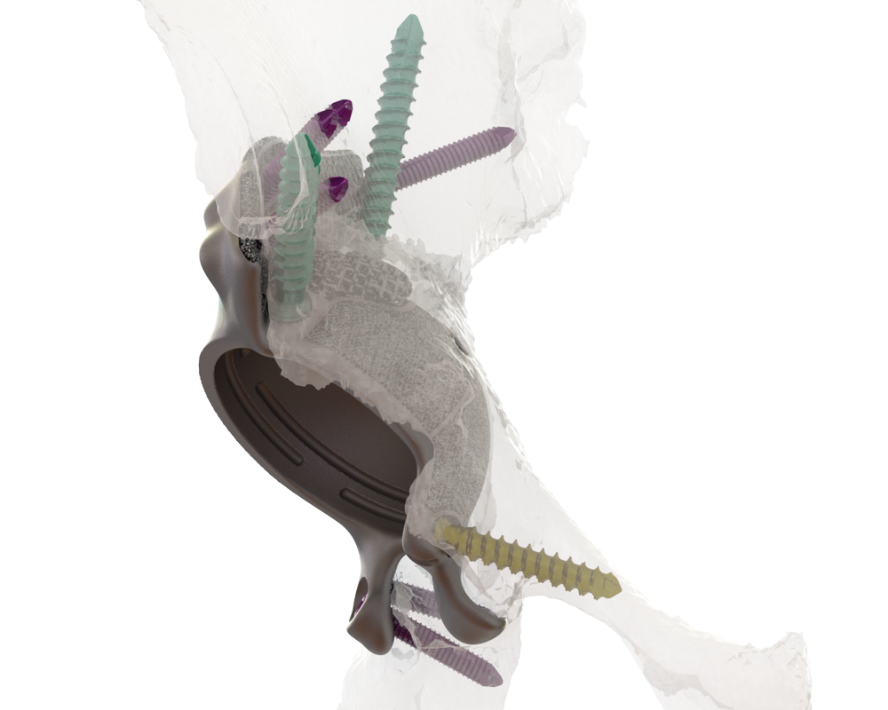 Lockedin with OSSIS Locking screws and fixedangle stability