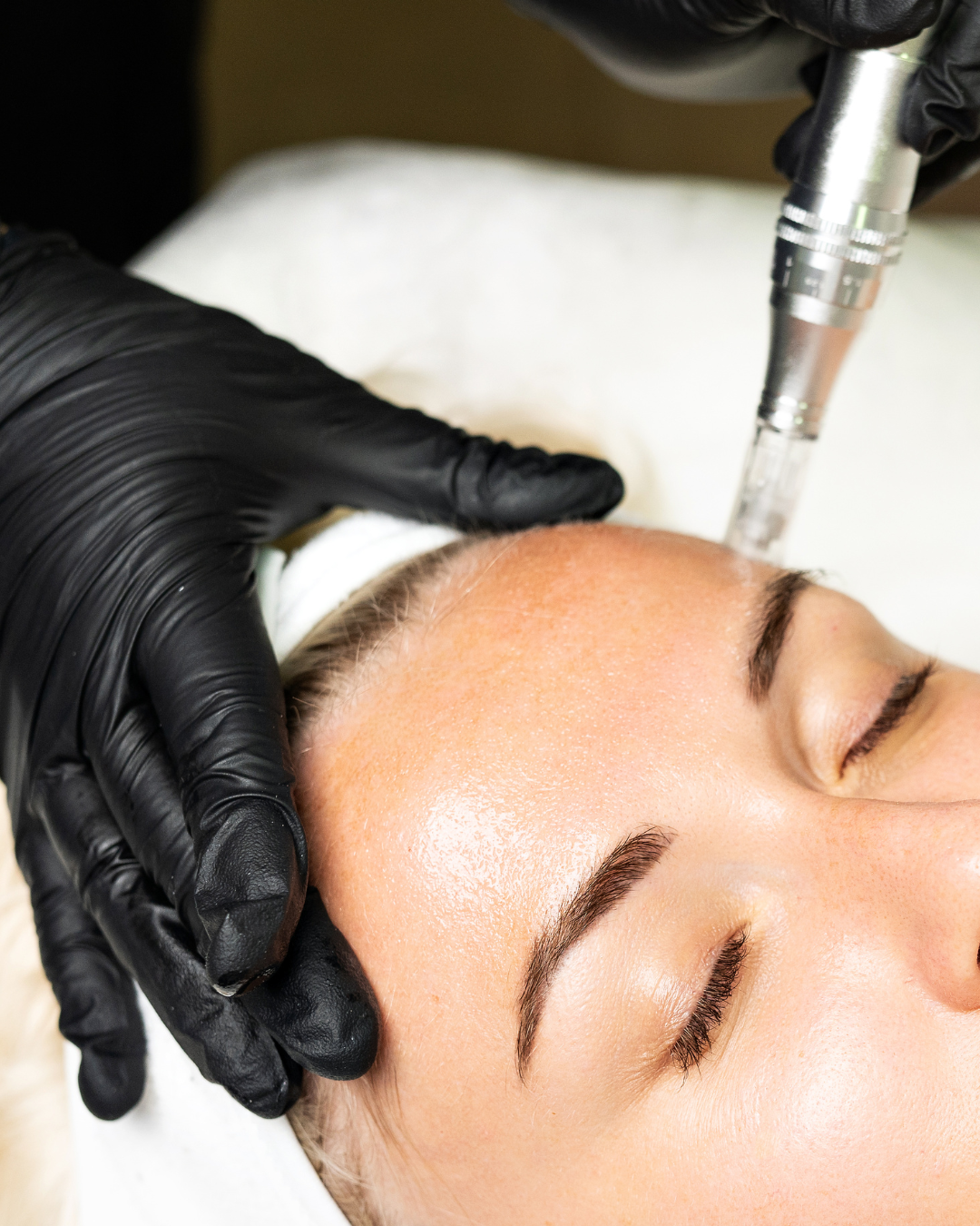 Close-up of a microneedling pen on a client's skin