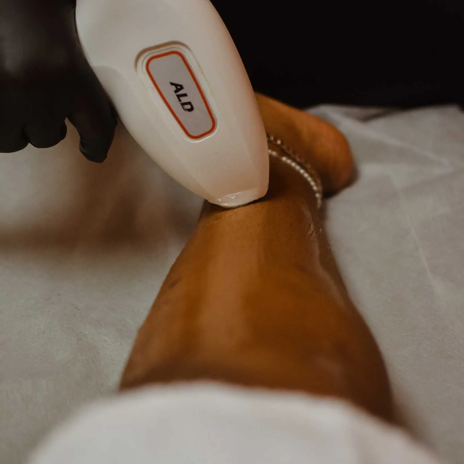 Close-up of a laser hair removal treatment on a client's leg
