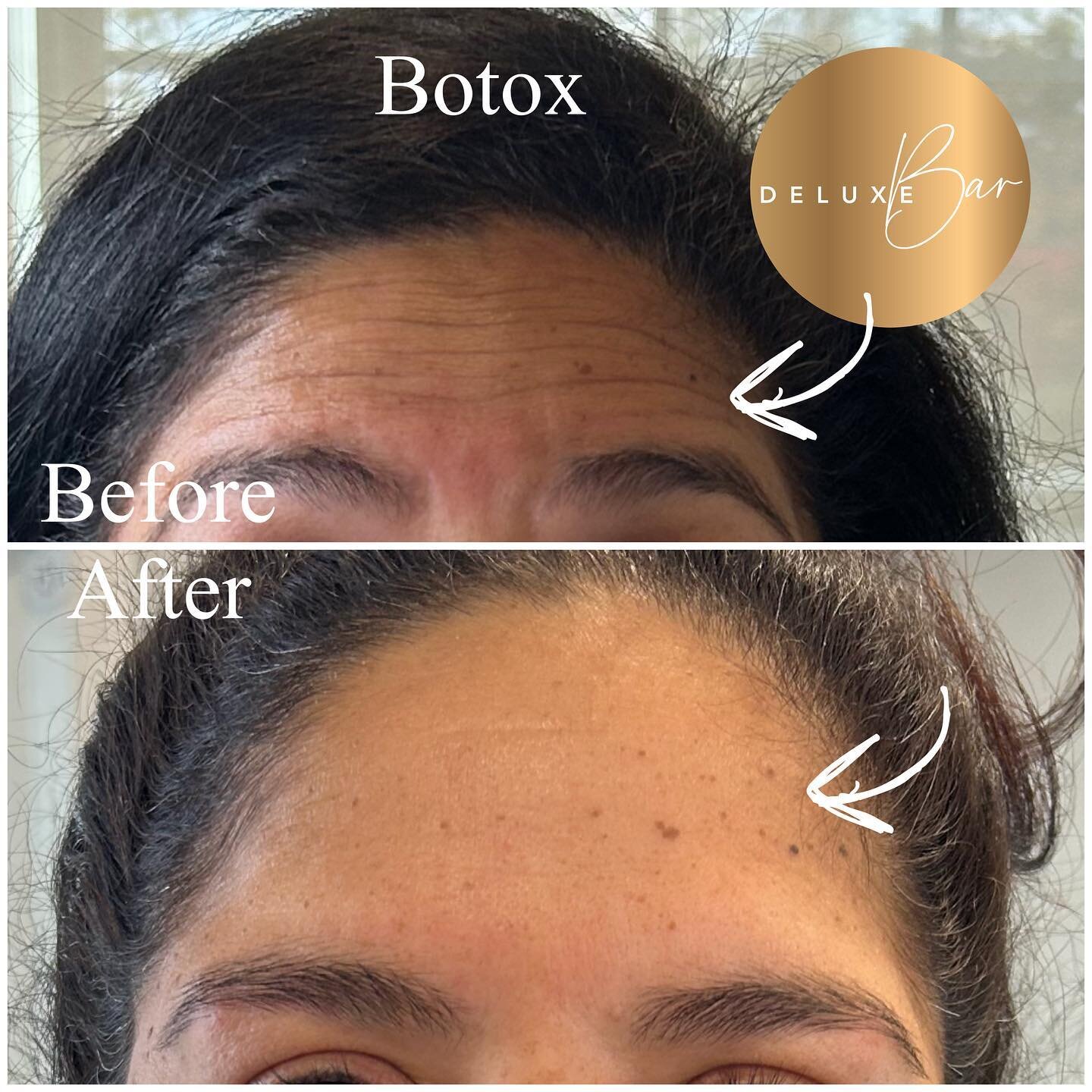 We are in a serious relationship with Botox. Glowing over these gorgeous results of Botox treatment to the frown lines and forehead ✨ 

There is still time to get in before the Holiday rush!  Call 781-561-0076 or book online thedeluxebar.com