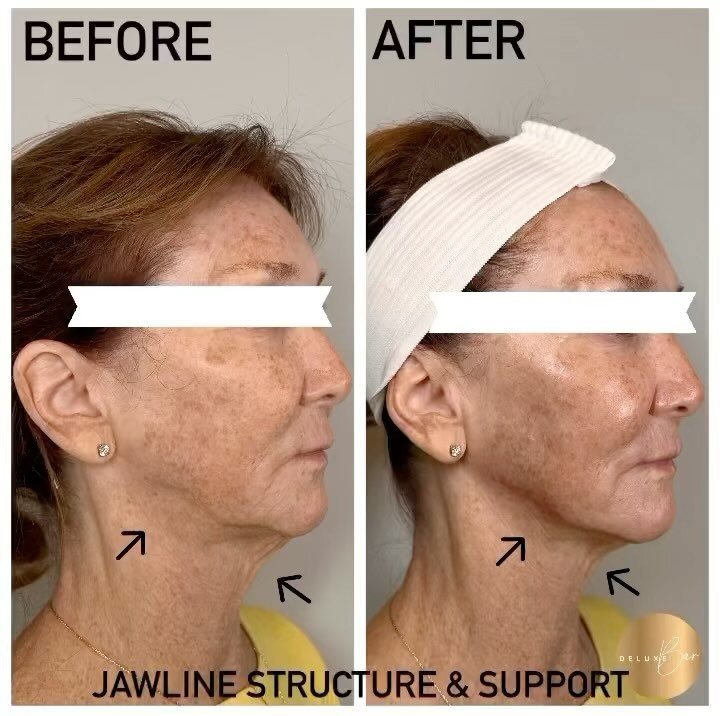 Filler + Calli = amazing results 👌🏻

Posted @withregram &bull; @confidencebycalli Creating structure, support and facial balance 🤌🏼🔥🤍

Call 781-561-0076 to schedule or book with me online at thedeluxebar.com 🤍
@thedeluxebar 

#jawline #jawline