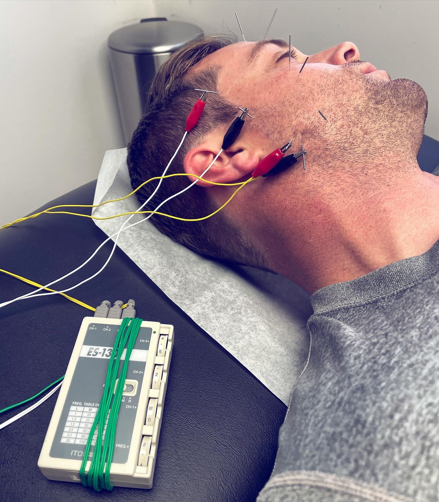 Dry Needling for later stage Bells Palsy Relief \\ 

#dryneedling #bellspalsy #face #fascialpain #inflammation #nervepain #accupuncture #sportschiro #chiropractor #sportsmed #edwardsville #stlouis #stlfitness #physio #physicaltherapy #movement #fitne