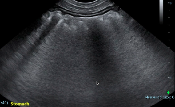 Gas filled stomach obscures visualization.