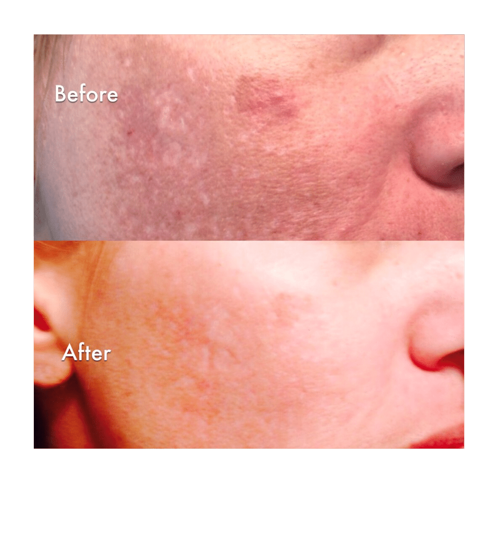 Hyperpigmentation + Acne Scar Reduction