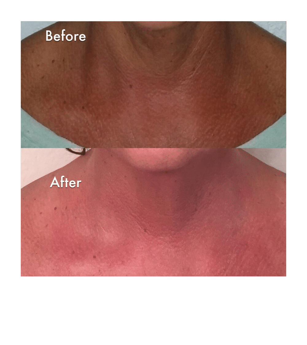 Skin Tightening and Even Pigmentation