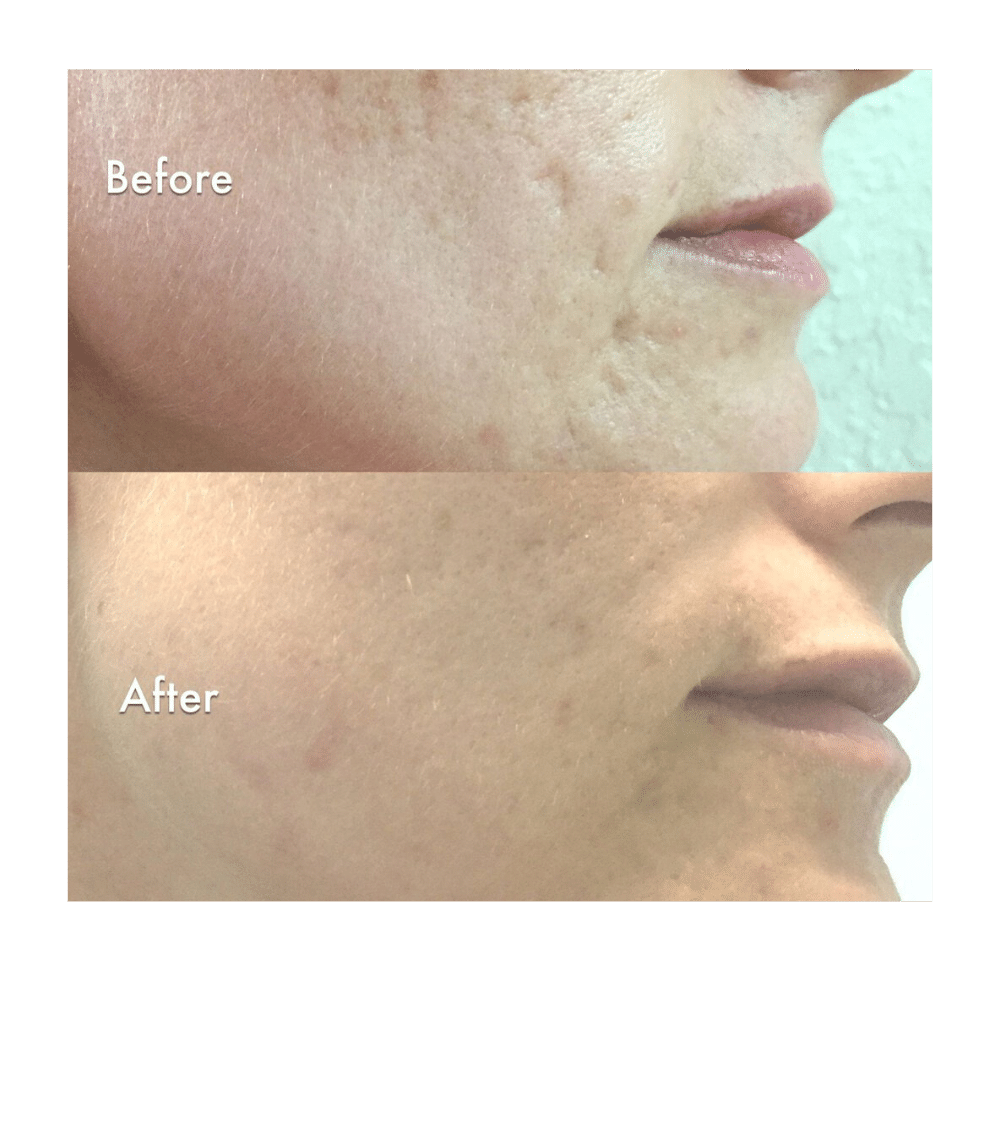 Acne Scar Reduction/Minimized Pores