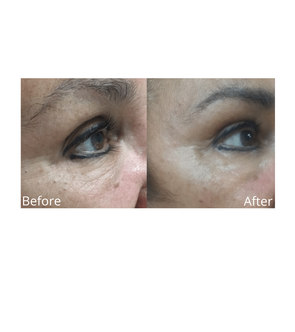 Hyperpigmentation/Wrinkle Reduction