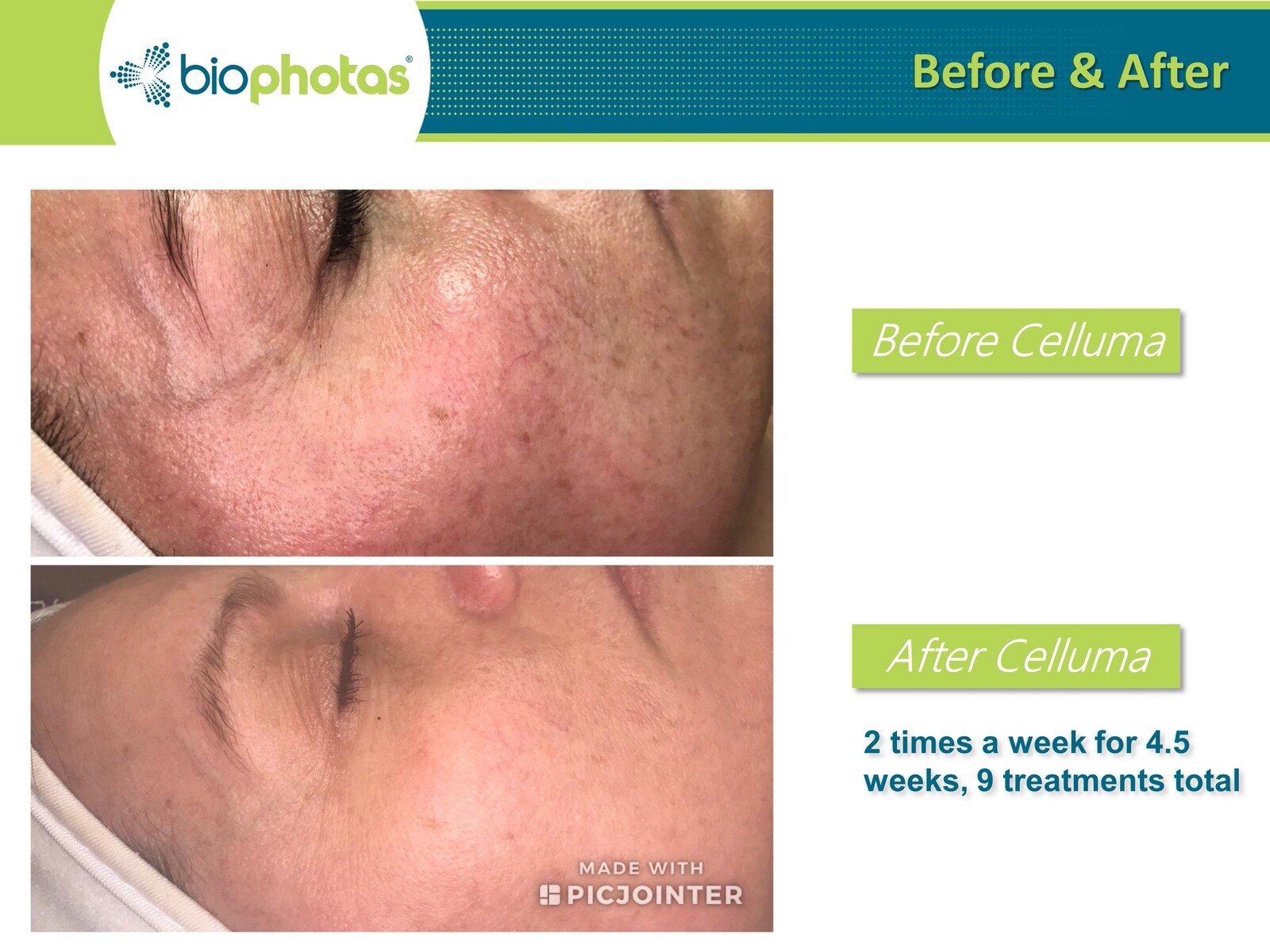 Before-After Celluma (19).JPG