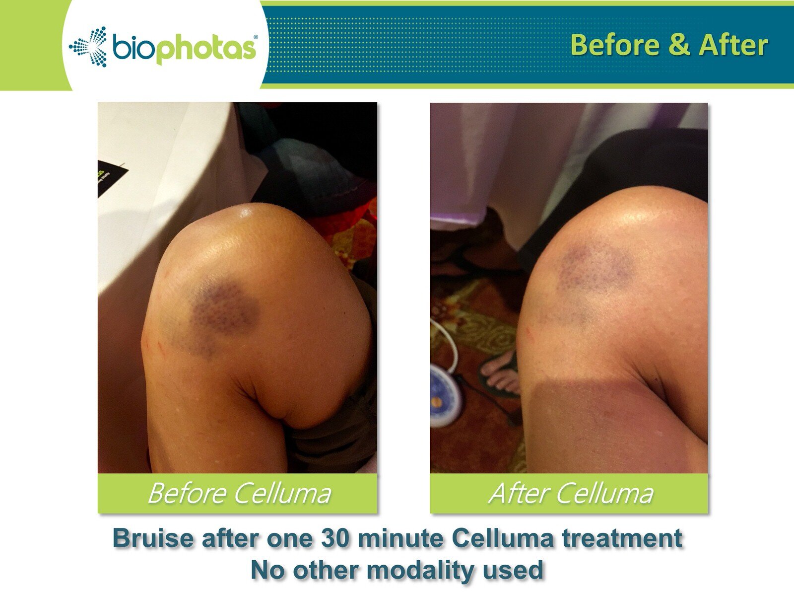 Before-After Celluma (20).JPG