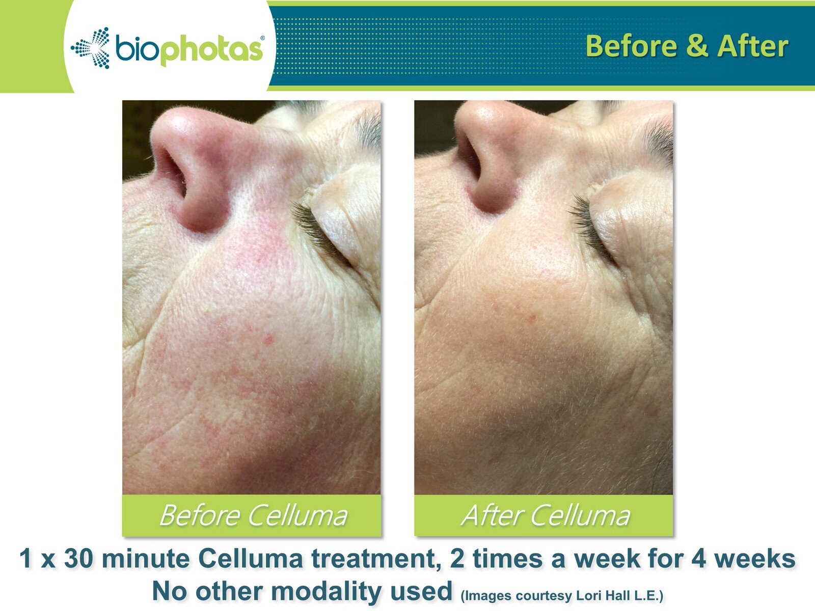 Before-After Celluma LED Light Therapy (15).JPG