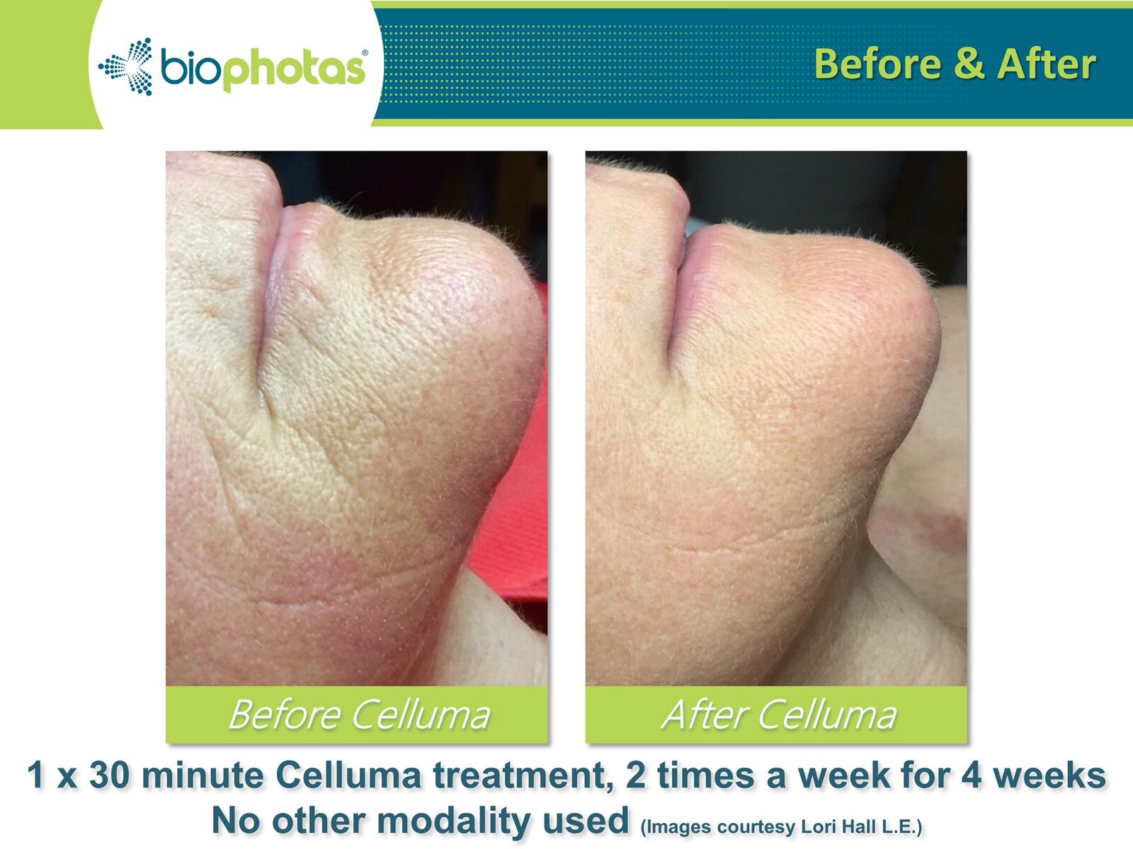 Before-After Celluma LED Light Therapy (16).JPG