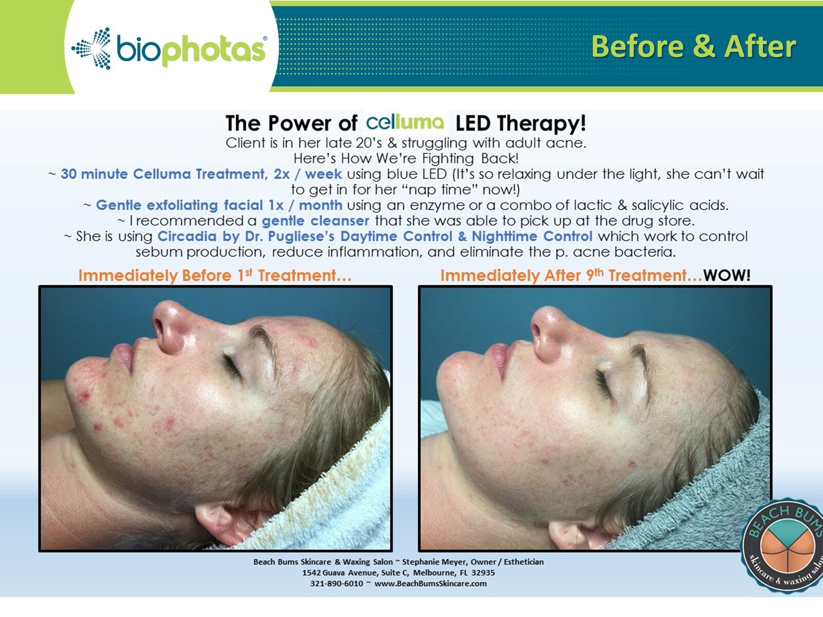Before-After Celluma LED Light Therapy (10).JPG