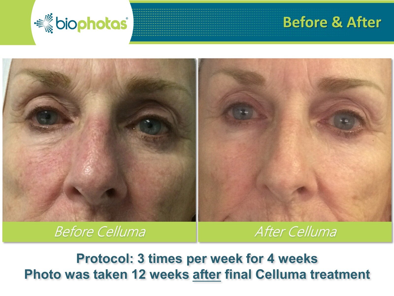 Before-After Celluma LED Light Therapy (12).JPG