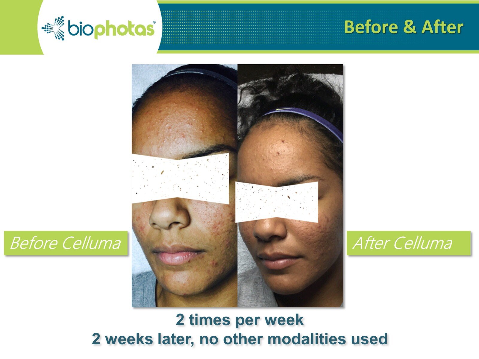 Before-After Celluma LED Light Therapy (9).JPG