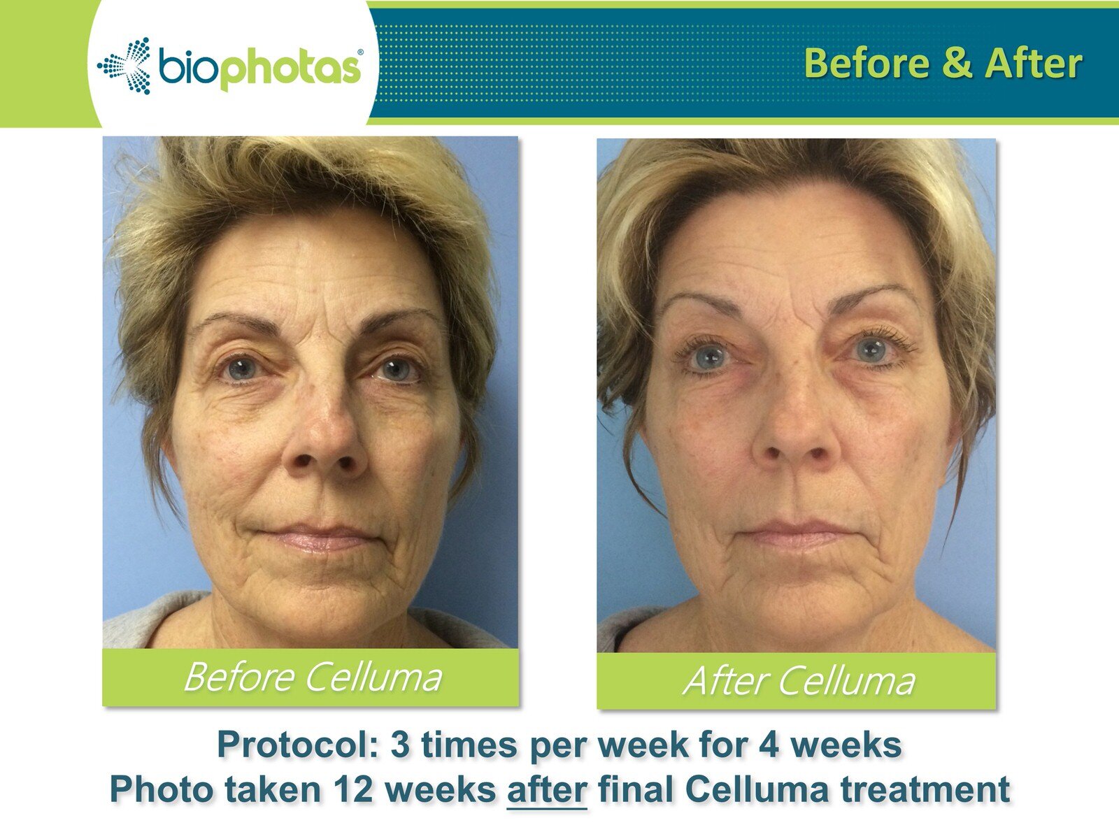 Before-After Celluma LED Light Therapy (11).JPG