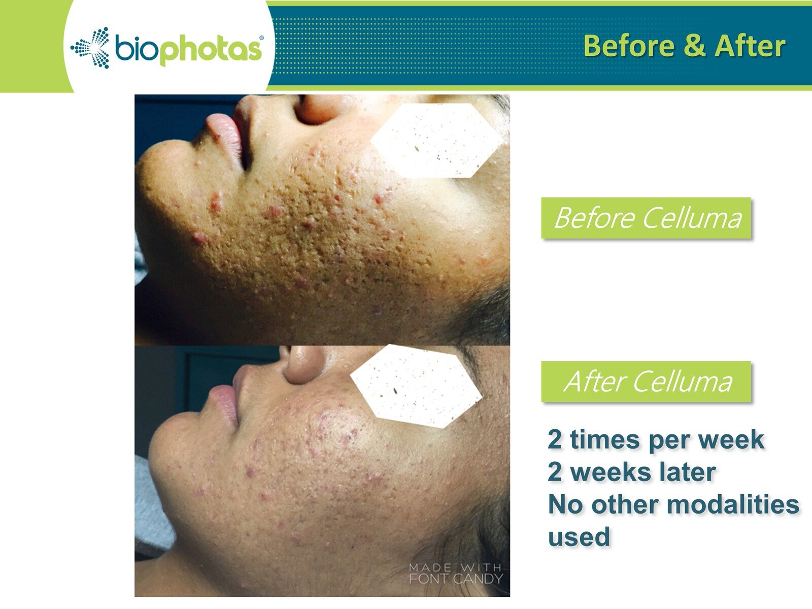 Before-After Celluma LED Light Therapy (8).JPG