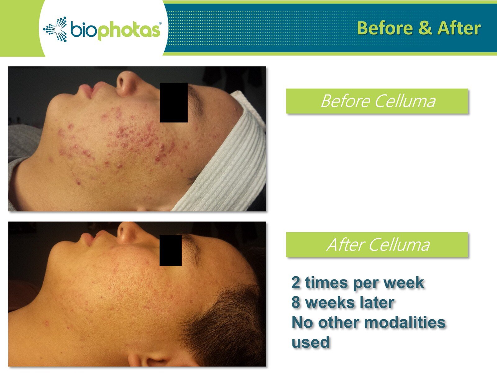 Before-After Celluma LED Light Therapy (4).JPG