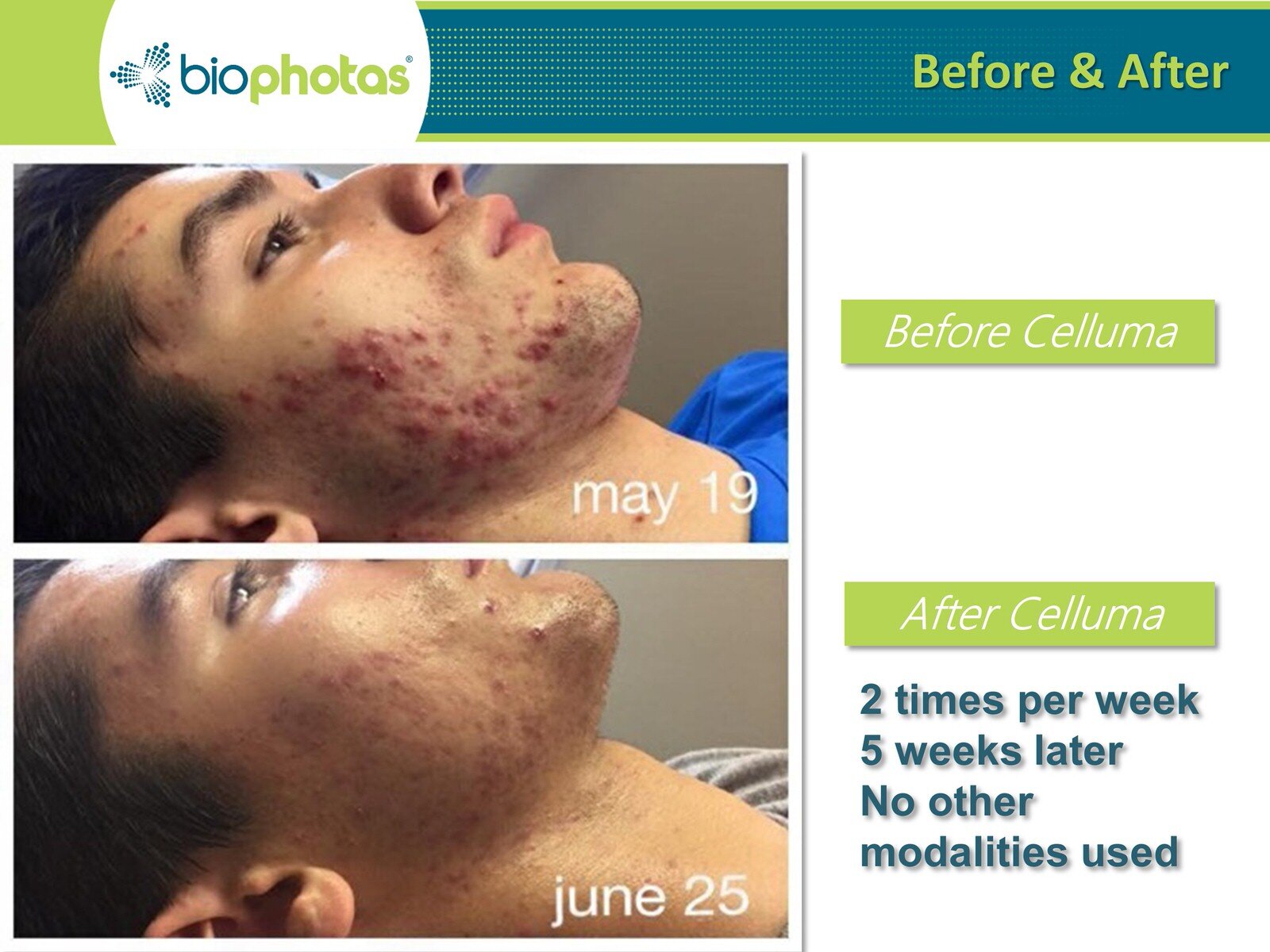 Before-After Celluma LED Light Therapy (5).JPG