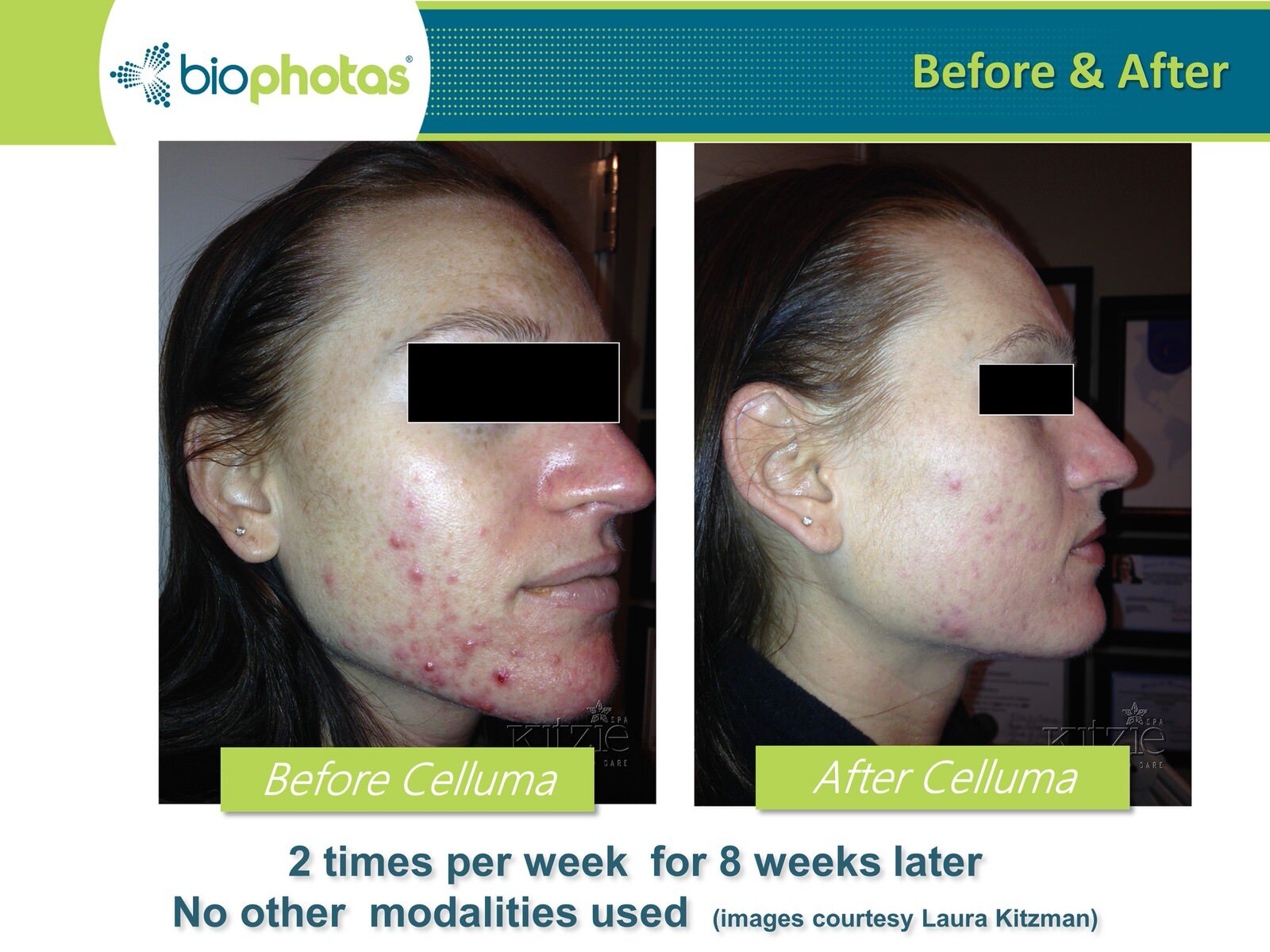 Before-After Celluma LED Light Therapy (6).JPG