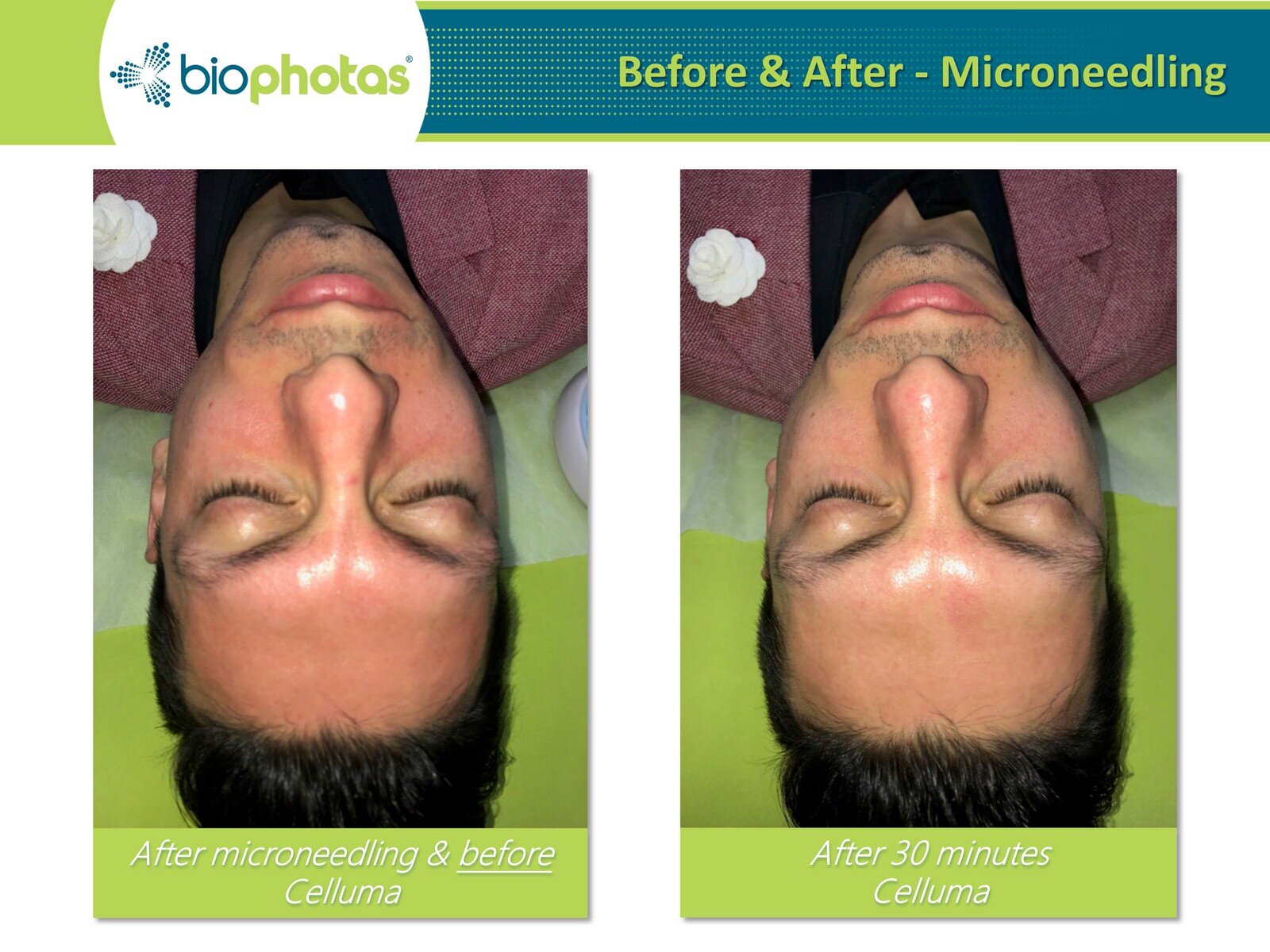 Before-After Celluma LED Light Therapy (2).JPG