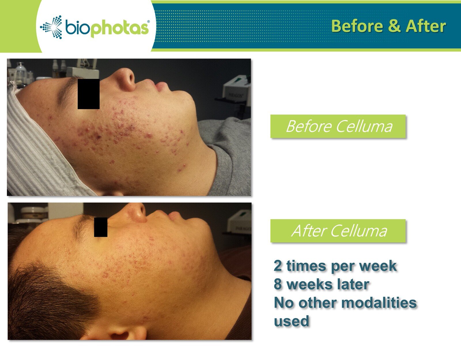 Before-After Celluma LED Light Therapy (3).JPG