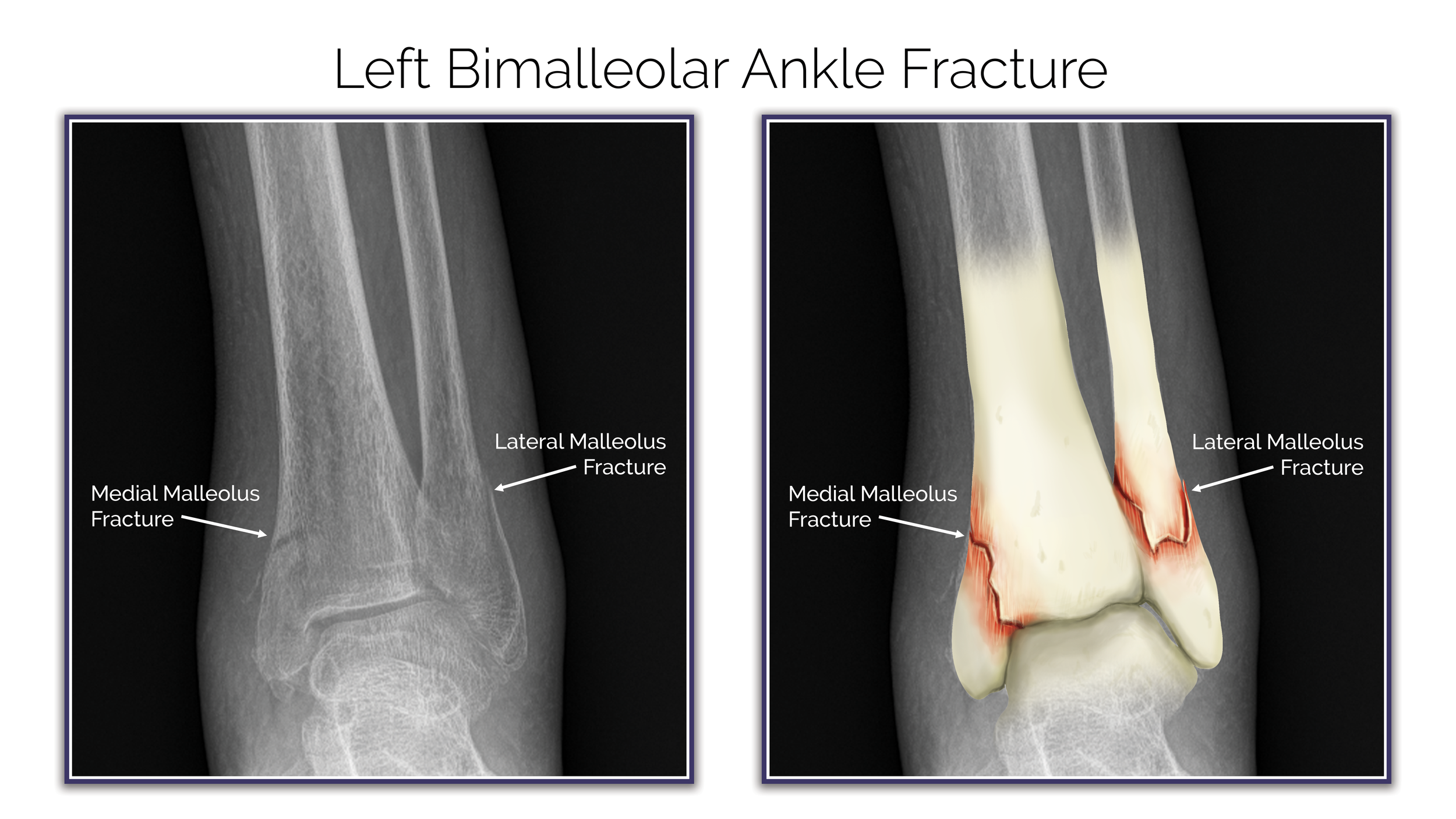 Bimalleolar Ankle Fracture