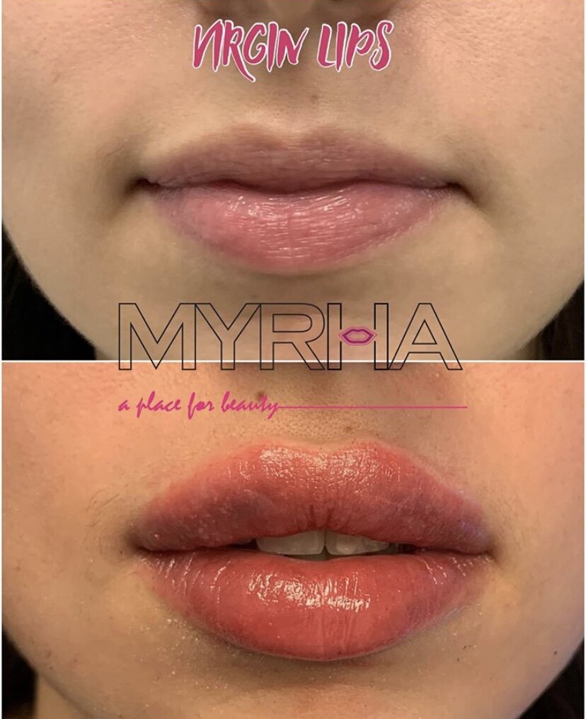 Lip Fillers Before and Afters, Ontario Canada