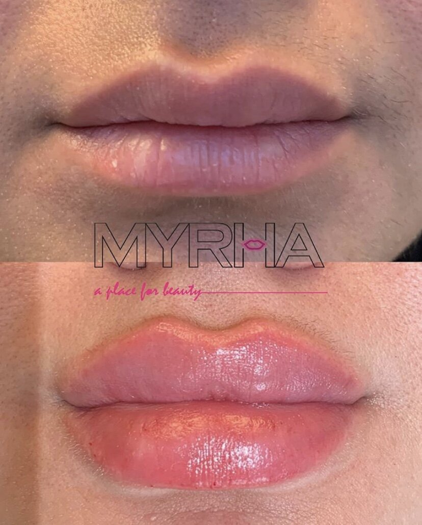 Lip Injector, Fillers in Ontario Canada