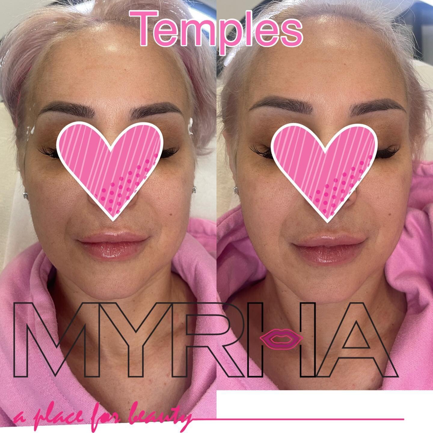Temples makes such difference. 
⠀
🅜🅨 🅦🅞🅡🅚 #6ixlips #myrhalips
𝙁𝙤𝙧 𝙋𝙧𝙤𝙛𝙚𝙨𝙨𝙞𝙤𝙣𝙖𝙡 𝙥𝙖𝙜𝙚, 𝙫𝙞𝙨𝙞𝙩:
𝗙𝗔𝗖𝗘 𝗪𝗢𝗥𝗞&nbsp;&nbsp;&nbsp;@myrha_beauty
𝗟𝗜𝗣 𝗪𝗢𝗥𝗞 @6ix_lips
𝗠𝗜𝗡𝗜 𝗙𝗔𝗖𝗘 𝗟𝗜𝗙𝗧 @lifted_snatched
⠀
Teosyal