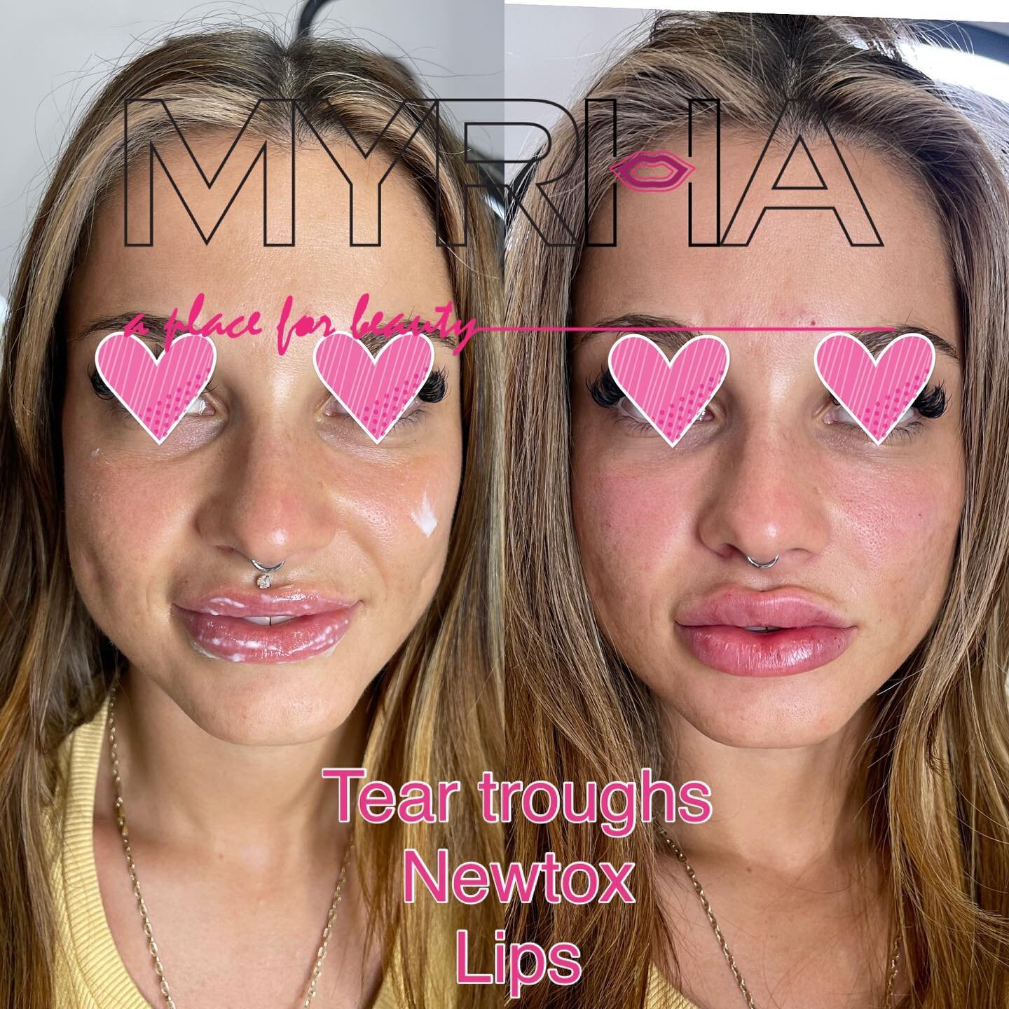 Keep them guessing. 
⠀
🅜🅨 🅦🅞🅡🅚 #6ixlips #myrhalips
𝙁𝙤𝙧 𝙋𝙧𝙤𝙛𝙚𝙨𝙨𝙞𝙤𝙣𝙖𝙡 𝙥𝙖𝙜𝙚, 𝙫𝙞𝙨𝙞𝙩:
𝗣𝗜𝗖𝗢𝗦𝗨𝗥𝗘 𝗣𝗥𝗢 𝗟𝗔𝗦𝗘𝗥 @freelovebeautyhealth
𝗙𝗔𝗖𝗘 𝗪𝗢𝗥𝗞&nbsp;&nbsp;&nbsp;@myrha_beauty
𝗟𝗜𝗣 𝗪𝗢𝗥𝗞 @6ix_lips
𝗠𝗜𝗡?