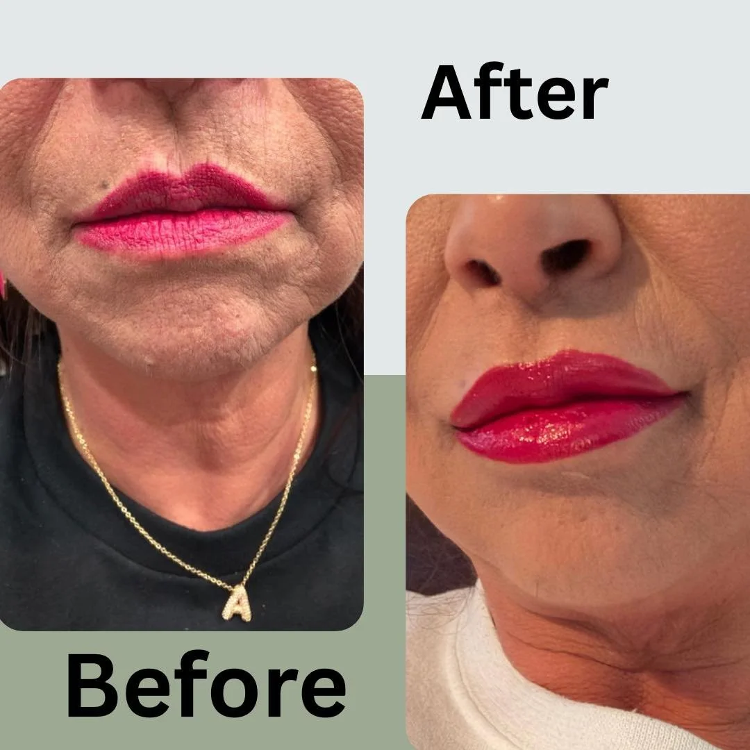 Side-by-side comparison of a woman's lips and lower face before and after cosmetic treatment, showing fuller, more defined lips after.