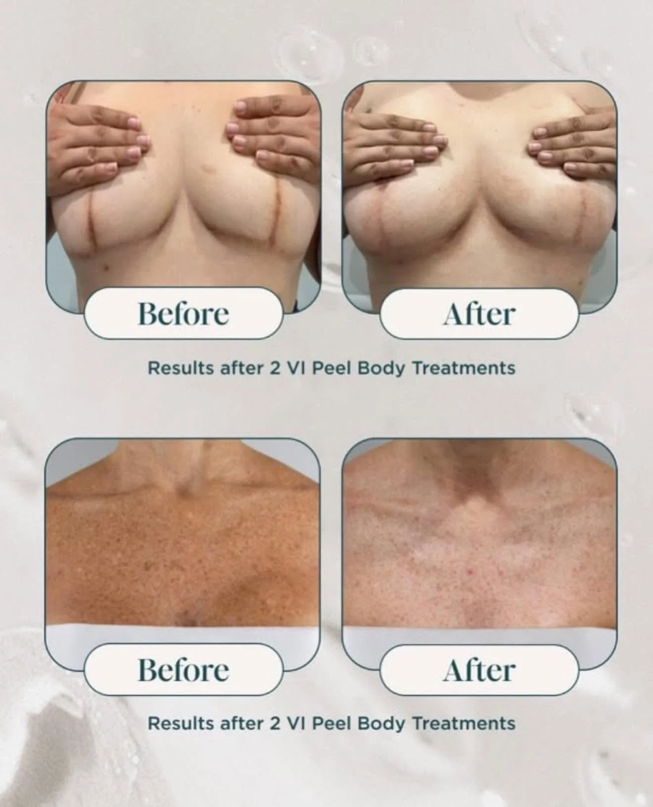 Comparison of before and after photos of a woman's body, showing improvements after two VI Peel Body Treatments. The top images display a woman’s chest with visible scars, before and after the treatments. The bottom images show the skin of a person's neck and chest, with the after photo displaying smoother, clearer skin.