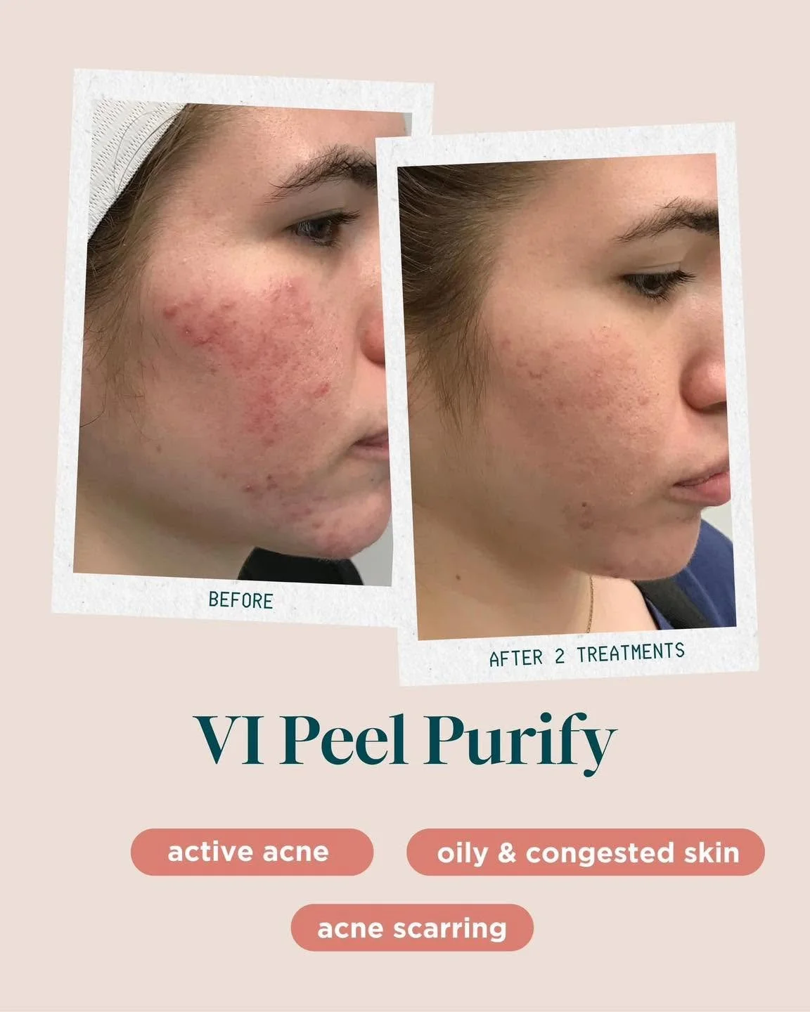 A comparison of a woman's face before and after two treatments of V I Peel Purify showing clear improvement in acne and skin condition.