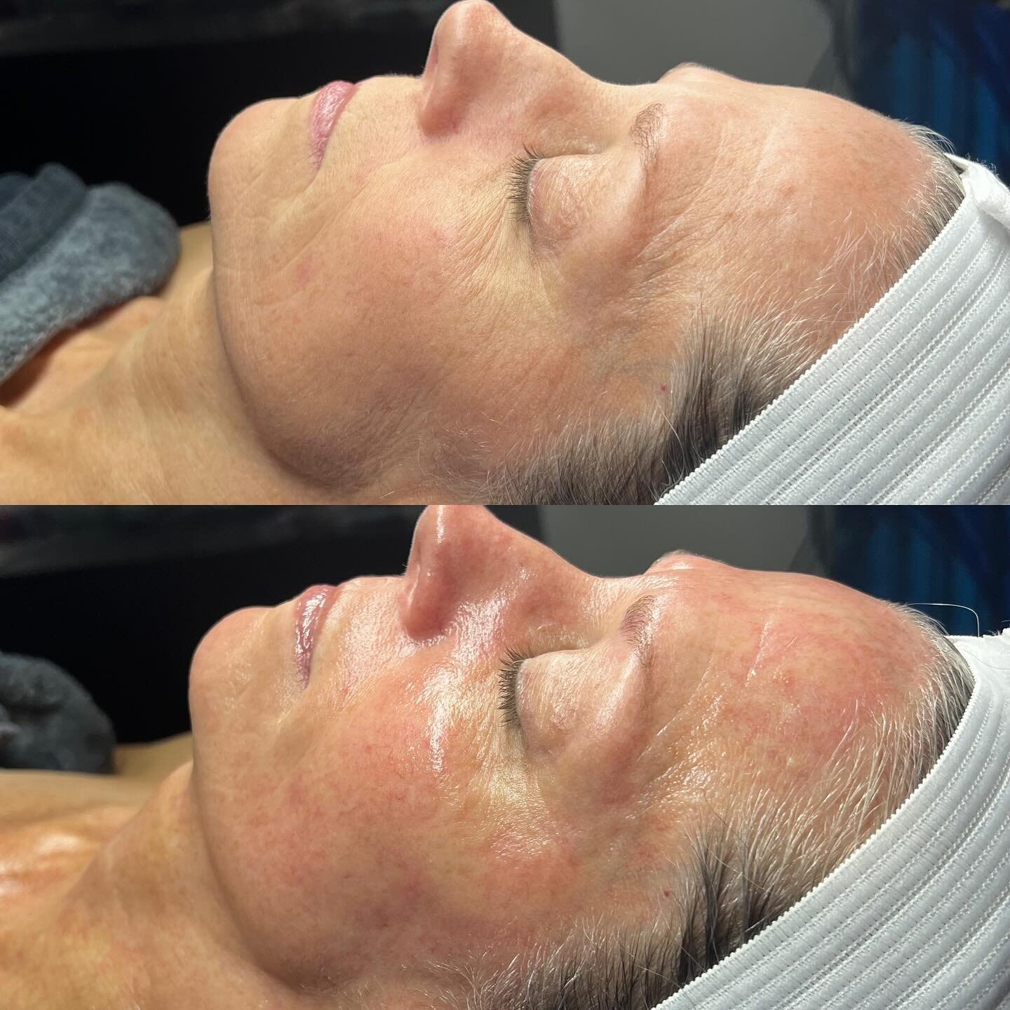 Beyond Botox Facial 😱

90 minutes of bliss that includes dermaplane, acid exfoliation and the time reversal ✨Firming Peptide Mask✨ notice this clients skin is noticeably tightened and lifted. The first and last pics recognize the tightening power fo