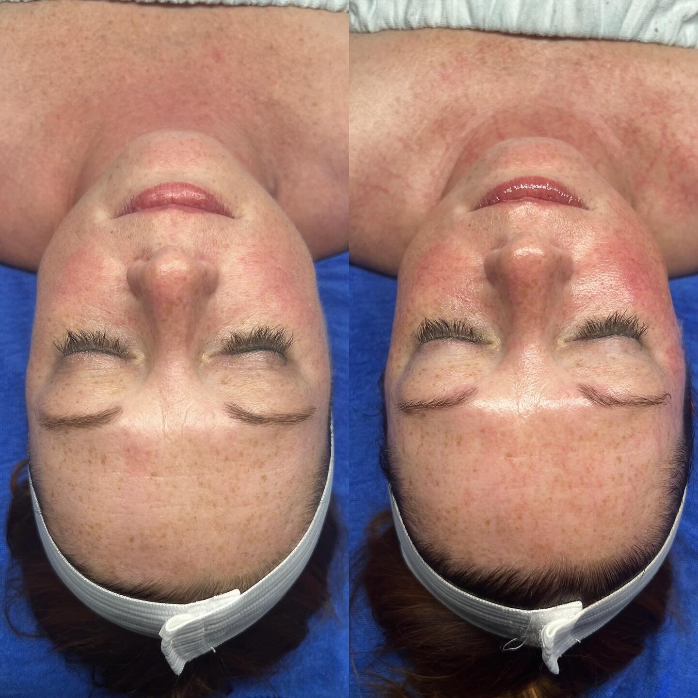Beyond Botox 🩵HydraFacial🩵

Take the amazing Beyond Botox Facial and combine it with a Platinum HydraFacial to get this MAGIC! The dilated capillaries (spider vein effect) show the magic really working, bringing in nutrients and flushing out waste.