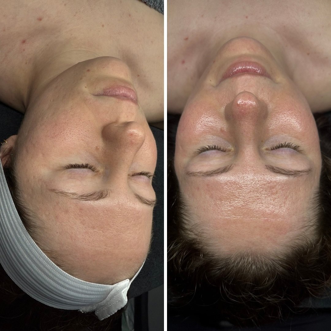 Glow like you mean it: Serenity Facial ✨
Step into a 90‑minute sanctuary of self-care:
🌿 Double cleanse with muscle stimulation to ease tension
🧖‍♀️ Hot towel ritual to soften and soothe
🔪 Dermaplaning + enzyme exfoliation for that polished,