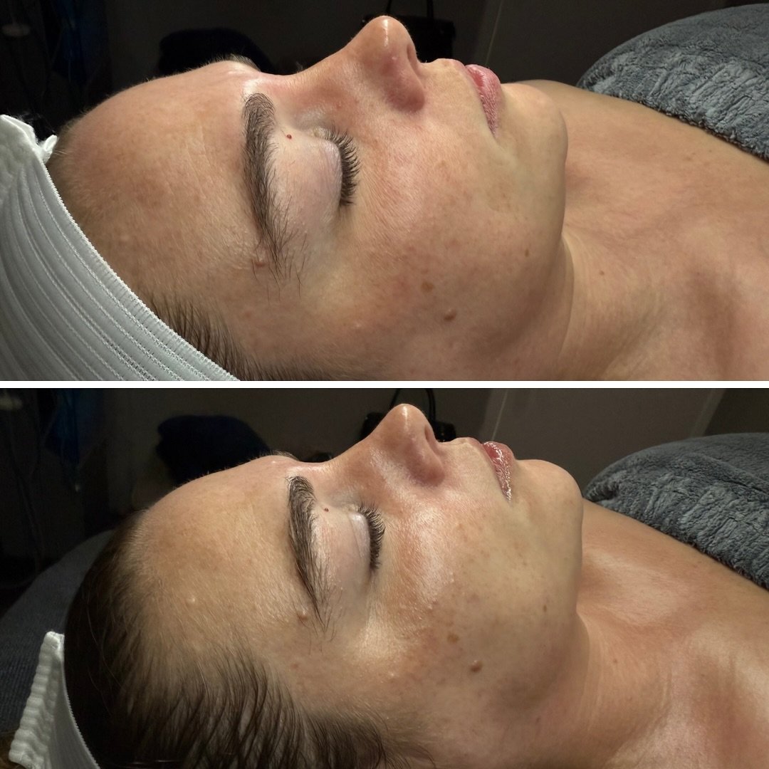 That before and after glow 😱
Facials give you an escape into bliss and relaxation, and leave you feeling refreshed and glowing. 😍
Link in bio has all information and contact points! Call, text or DM me directly on here with any questions!
832-7