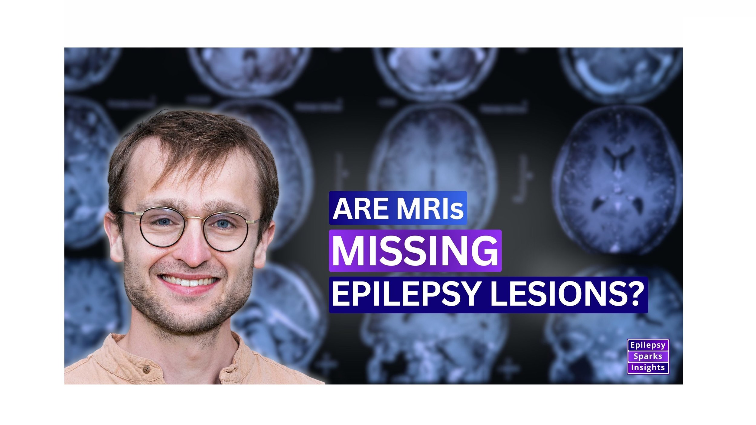       
  
     MRIs Miss Brain Lesions Causing Epilepsy - AI Can Find Them  - Dr. Konrad Wagstyl,  KCL &amp; UCL Great Ormond Street Institute of Child Health, UK  Many epilepsy lesions that cause seizures are missed on routine MRI scans, delaying ac