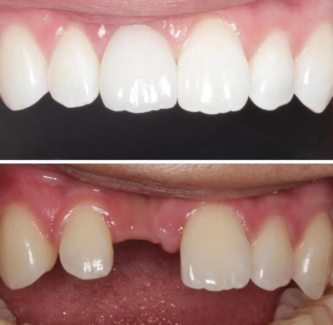 Case Study #11:  Implant And Chair-side Modifications Before and After All NEw Smiles