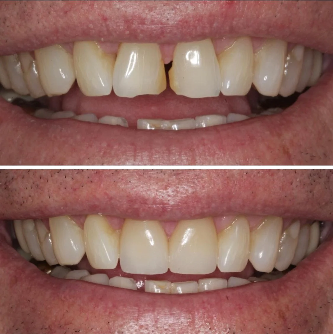 All New Smiles Bay Area CA Case Study #9: Porcelain Veneers Front Two Teeth Before and After