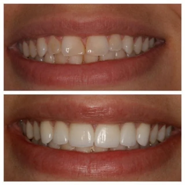 Case Study #10: Six Porcelain Veneers On Upper Teeth Before and After - Oakland Dentist