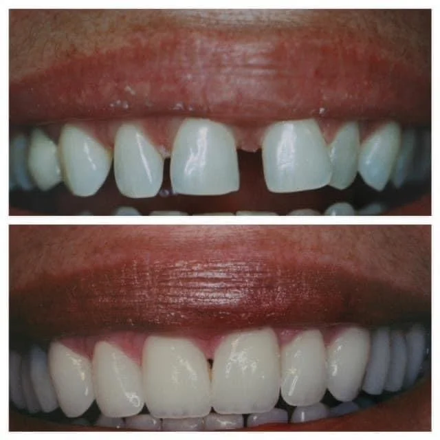 Case Study #12:  Porcelain Veneers To Close The Gaps Between Teeth Before and After at All New Smiles