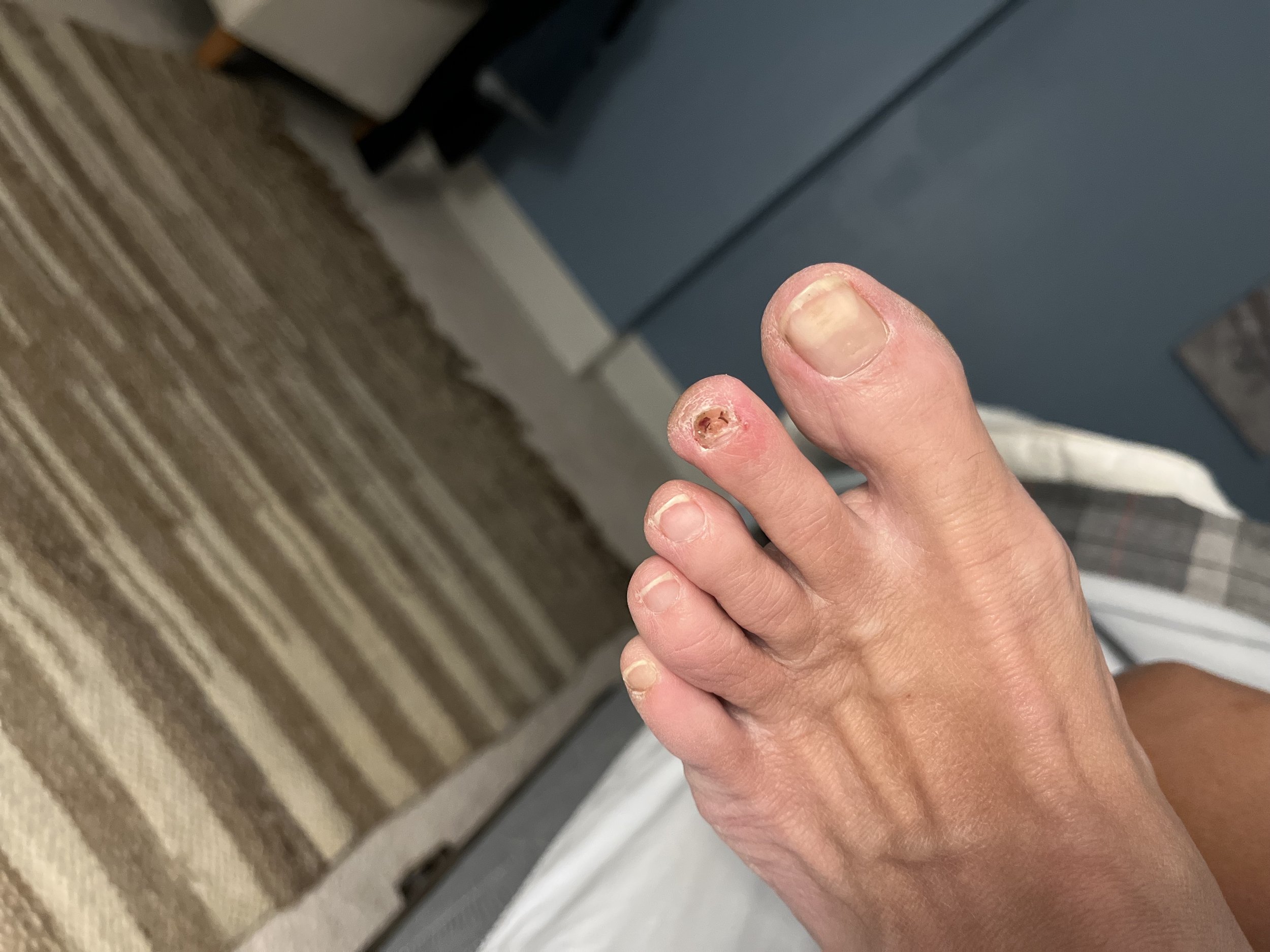 losttoenail.jpg