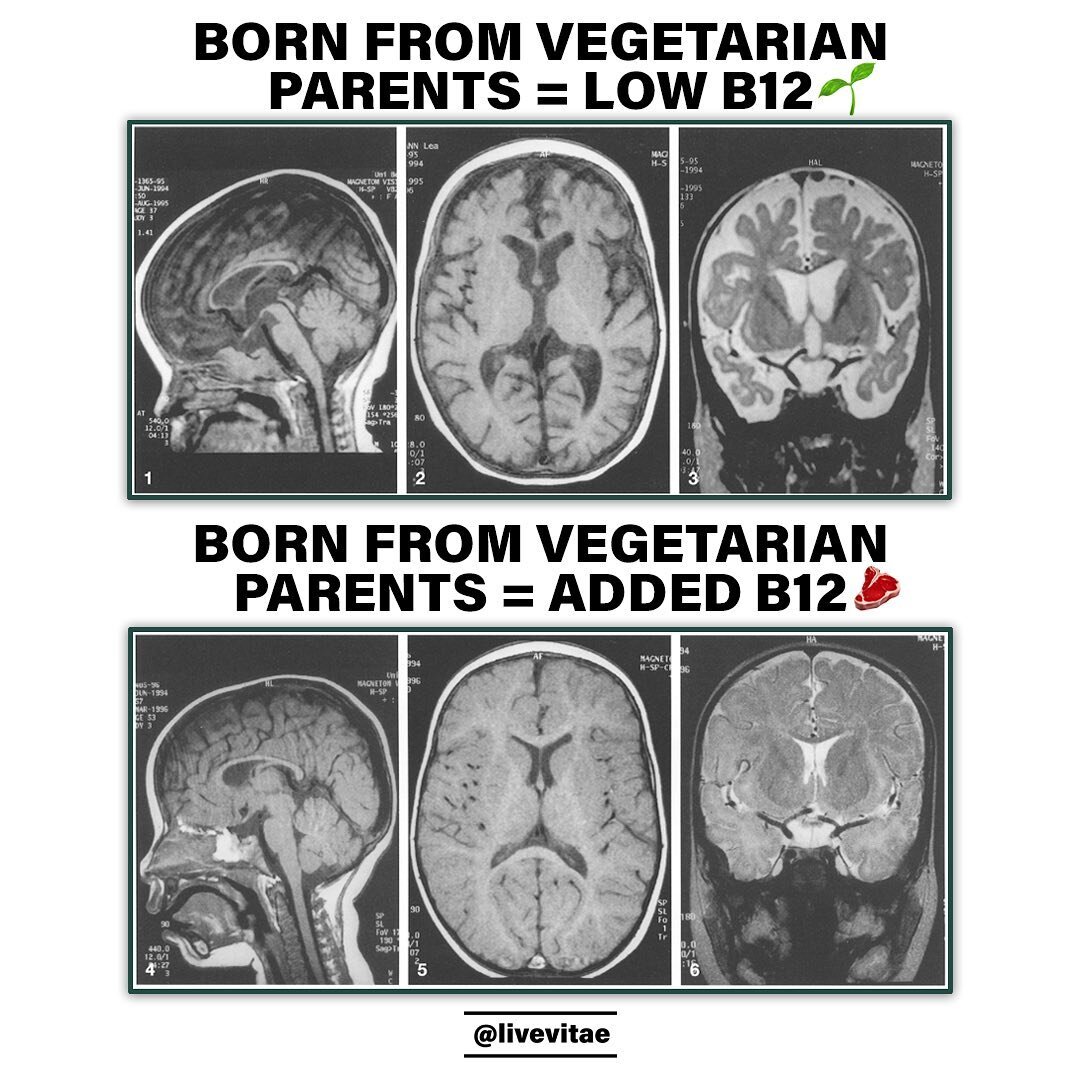 You&rsquo;re looking at a 14.5-month child born from vegetarian parents with the neurological disease - brain atrophy.

An important message/image that most plant-based advocates fail to mention or share, and yet our future generations might devolve 