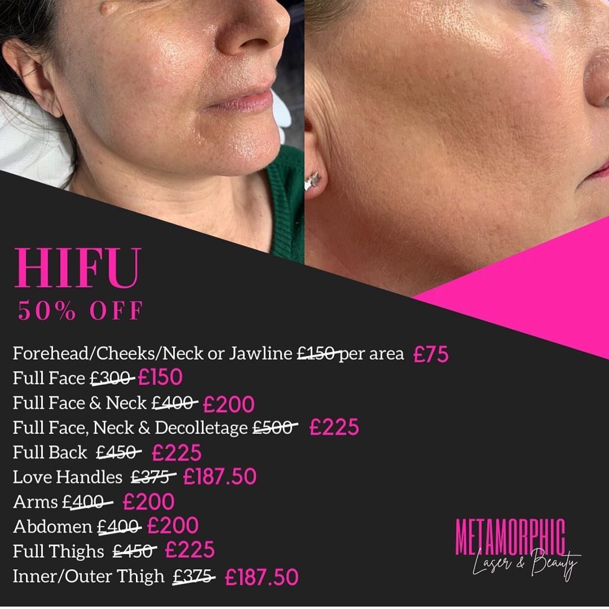 @metamorphicaesthetics has an amazing offer on yet another treatment! DM her to book in! #tattoo #tattoos #beauty #hifu #hifutreatment #hifustowmarket #laserhairremoval #laserhairremovaltreatment #beautytreatment #love #follow #beautystowmarket #alte