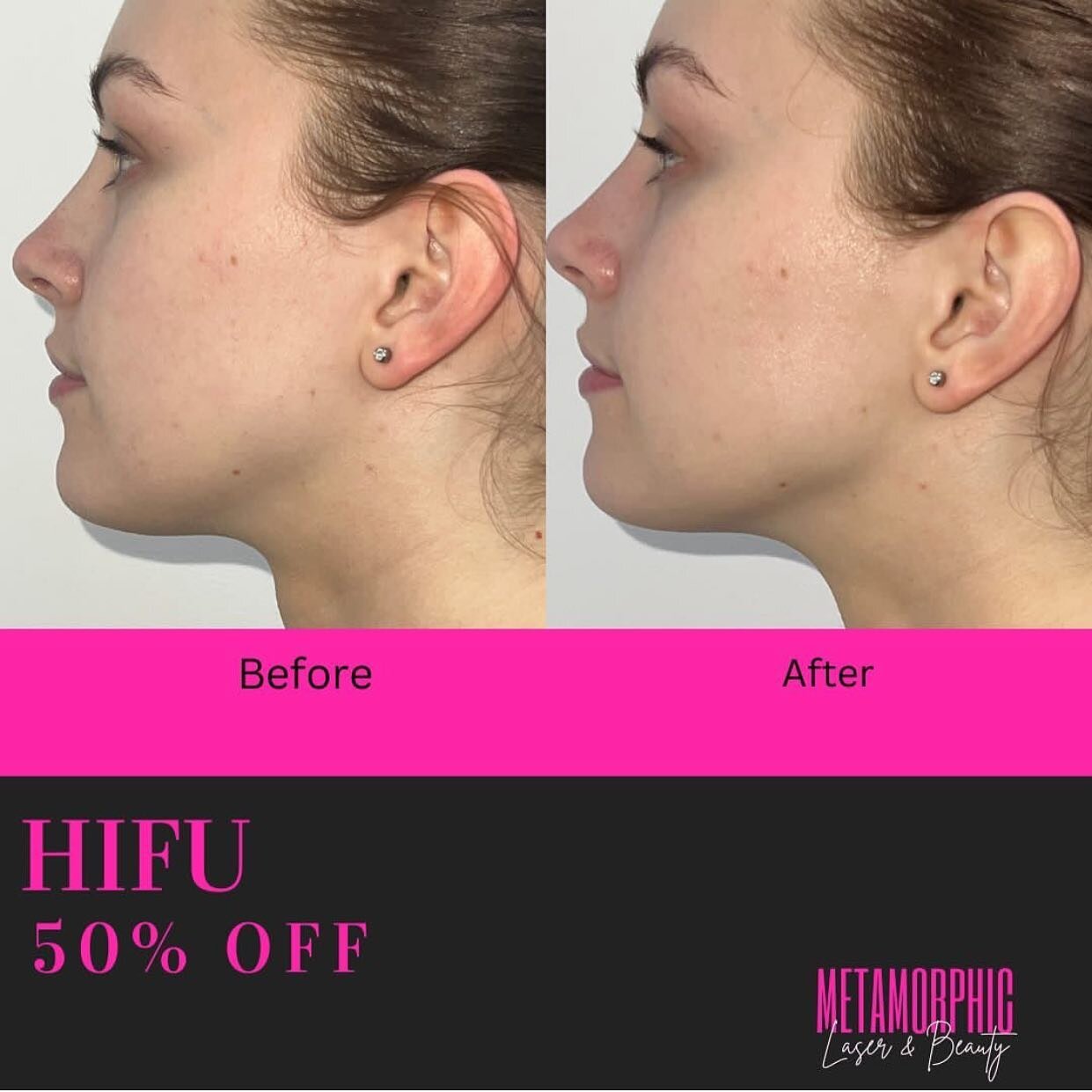 Discounted Hifu treatments with @metamorphicaesthetics please DM them to enquire! #beauty #beautytreatments #hifu #hifutreatment #like #love #follow #special #specialoffer